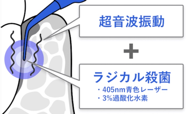 ブルーラジカル