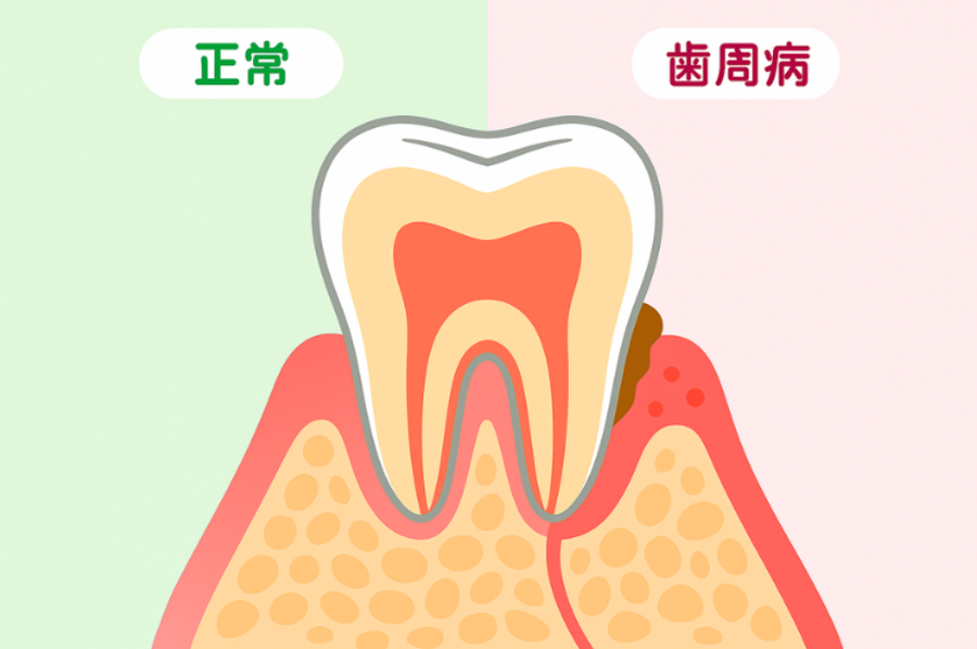 歯周病
