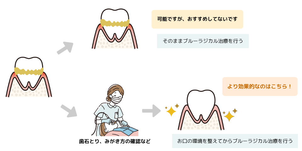 歯周病